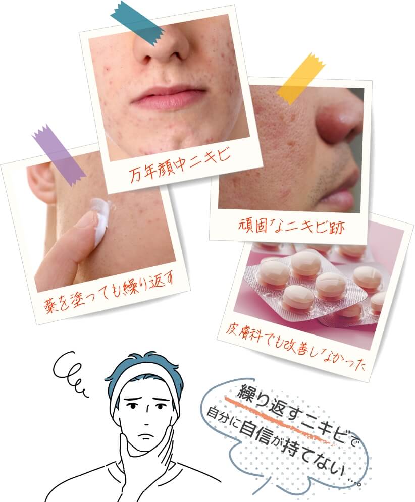 薬を塗っても繰り返す 万年顔中ニキビ 頑固なニキビ跡 皮膚科でも改善しなかった 繰り返すニキビで自分に自信が持てない…。
