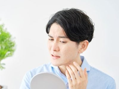 ニキビに残る白い「芯」はどうしたらいいの？？