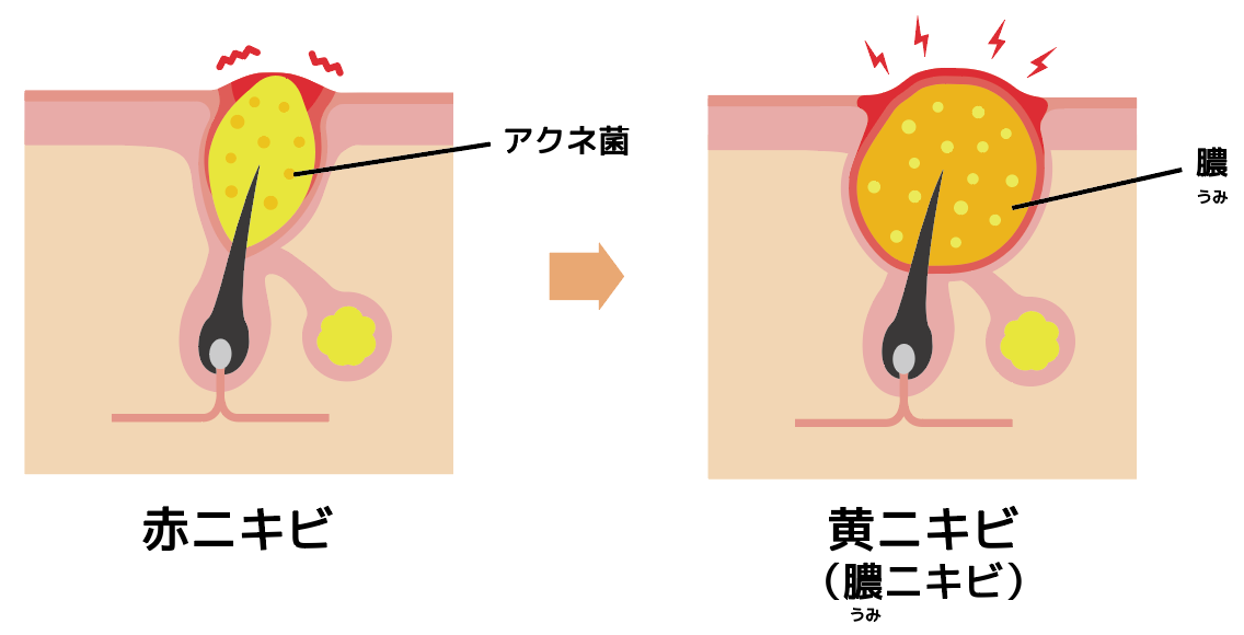 ニキビにしこりみたいな芯が 正体の見分け方とケアの方法