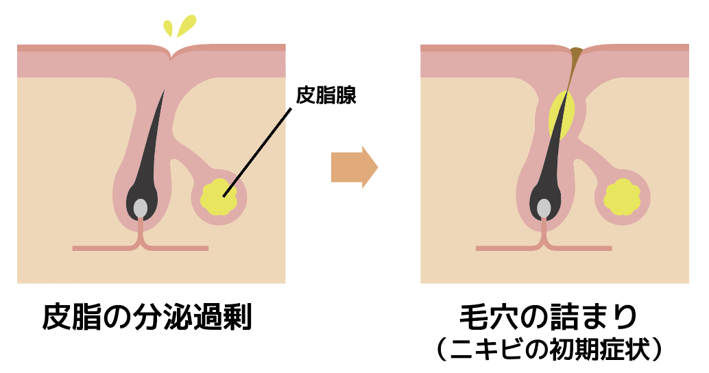 ニキビにしこりみたいな芯が 正体の見分け方とケアの方法