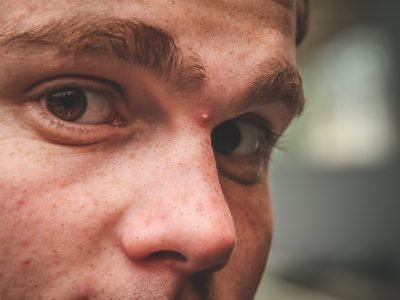 男の鼻のニキビは悪化に注意 汚れと皮脂のケア方法は