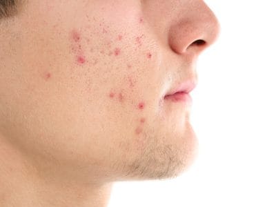 なかなか治らない、目立つ頬のニキビ。どうしたらいいの？
