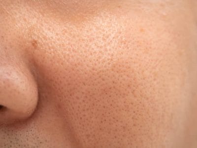 毛穴には皮脂汚れがいっぱい！ニキビの原因に